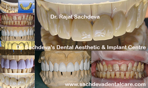 Dental Courses In Delhi,cosmetic dental surgery in delhi ,cosmetic dentist in delhi,Dental Implants Clinic in Delhi,cosmetic dentist delhi,dentist in delhi,dental implant courses in delhi,cost of tooth implant in delhi,tooth implant cost in delhi,cosmetic dentistry in delhi,dental clinic in delhi,laser dentistry courses in delhi,cosmetic dental surgery Delhi